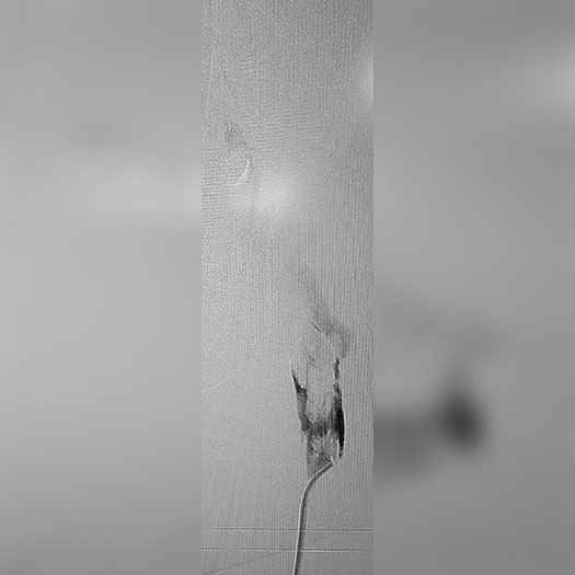 angiogram of occluded iliofemoral vein