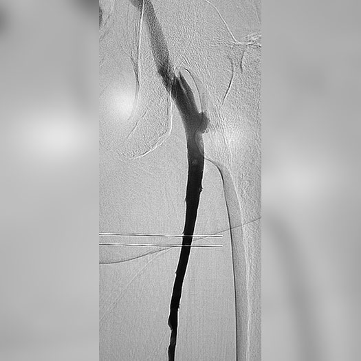 angiogram of cleared iliofemoral vein