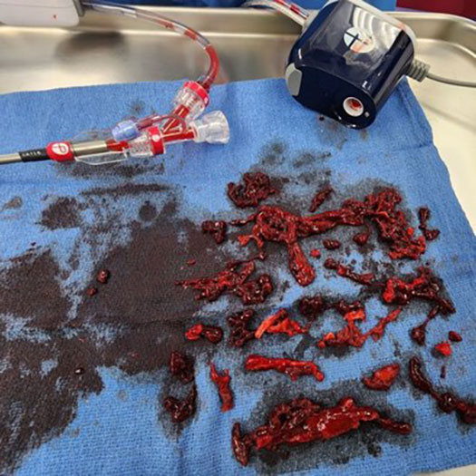 blood clot from iliofemoral vein