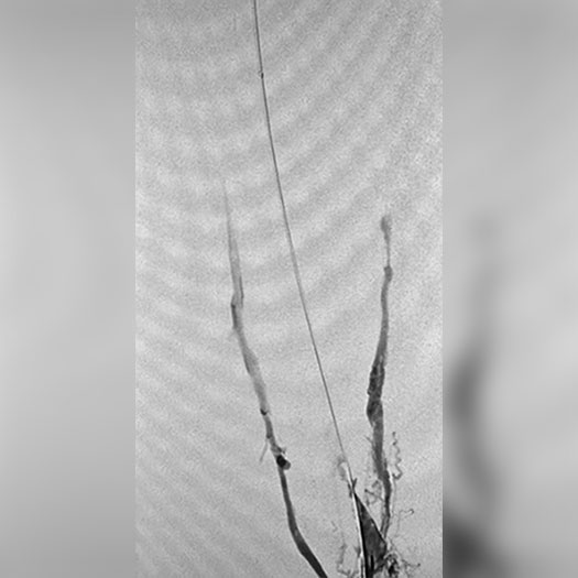 angiogram of occluded iliofemoral vein