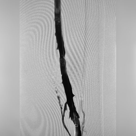 angiogram of cleared iliofemoral vein