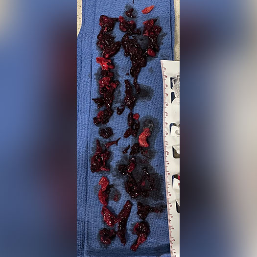 blood clot from iliofemoral vein on blue gauze pad