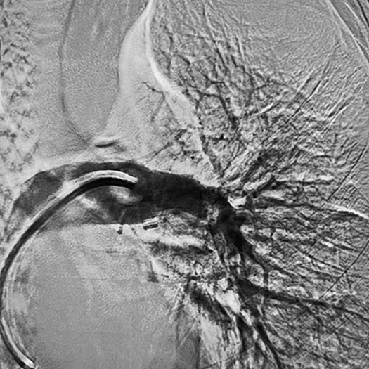 angiogram of occluded blood vessel in the lung