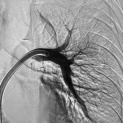 angiogram of cleared blood vessel in the lung