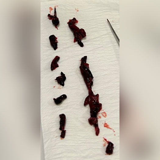 Blood Clot from Left-Sided Pulmonary Embolism