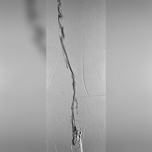 angiogram of occluded femoral artery