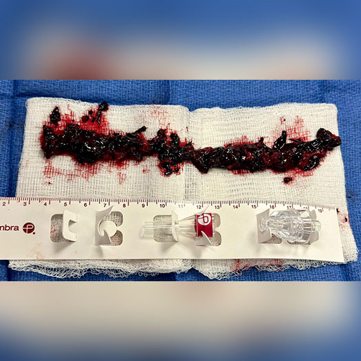 Blood Clot from femoral artery