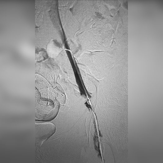 Angiogram of peripheral access in femoral artery