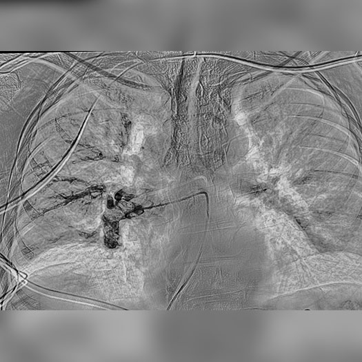 angiogram of occluded blood vessel in both the lungs