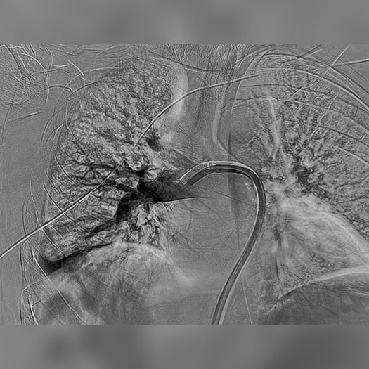 angiogram of cleared blood vessel in both the lungs