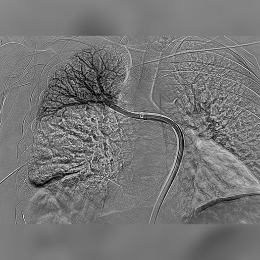 angiogram of cleared blood vessel in both the lungs