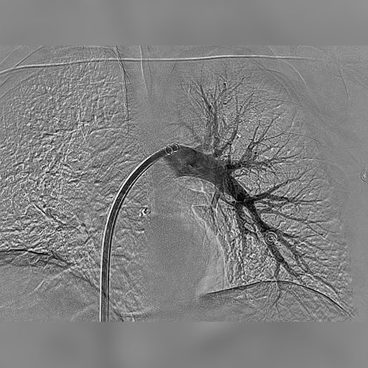 angiogram of cleared blood vessel in both the lungs