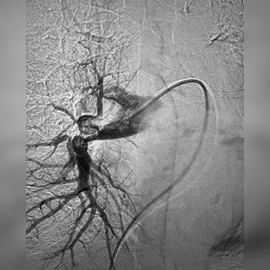 angiogram of occluded blood vessel in the lung