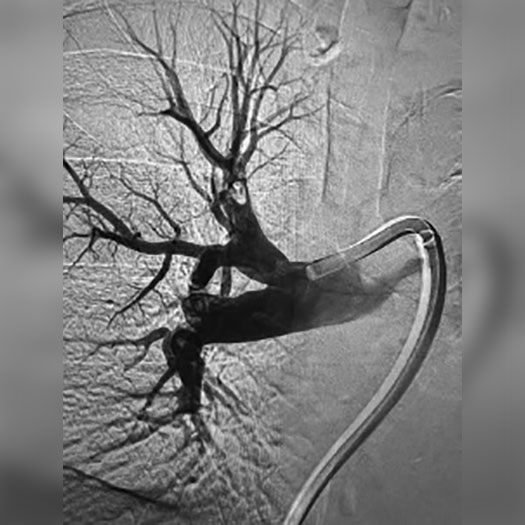angiogram of cleared blood vessel in the lung
