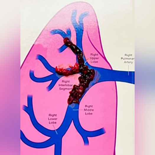 blood clot from right-sided pulmonary embolism