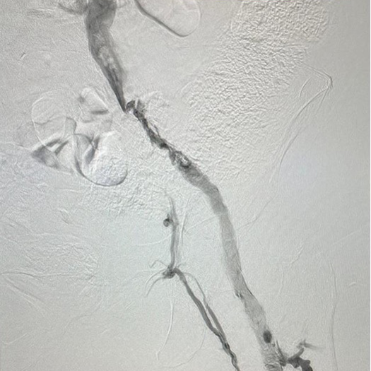 angiogram of occluded iliofemoral vein