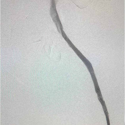 angiogram of cleared iliofemoral vein