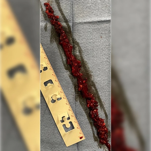 Blood Clot from Iliofemoral Vein