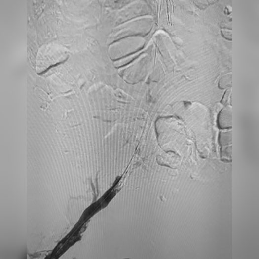 angiogram of occluded iliac vein