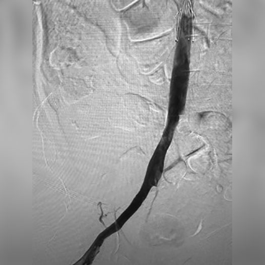 angiogram of cleared iliac vein
