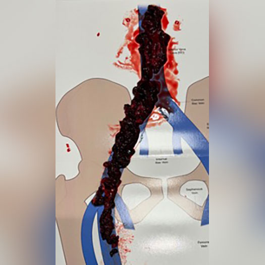 Blood Clot from Iliac Vein