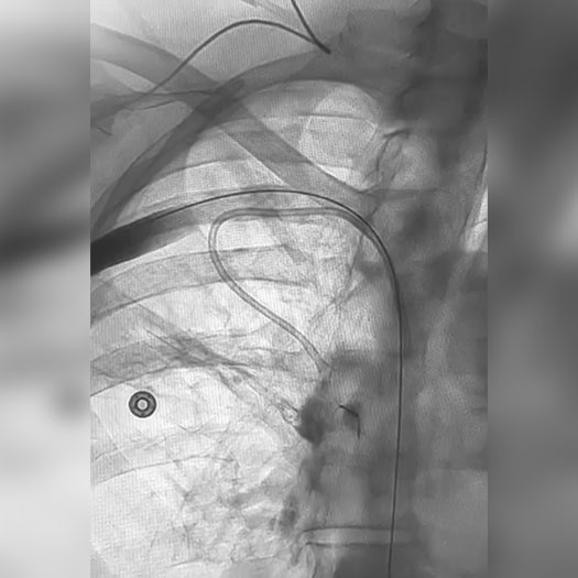 Angiogram of occluded blood vessel in upper extremity