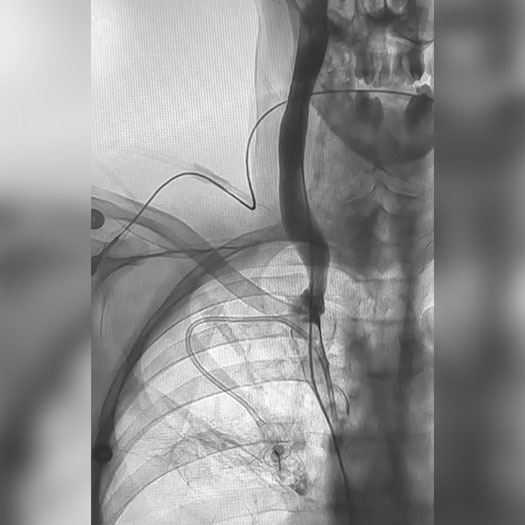 Angiogram of occluded blood vessel in upper extremity