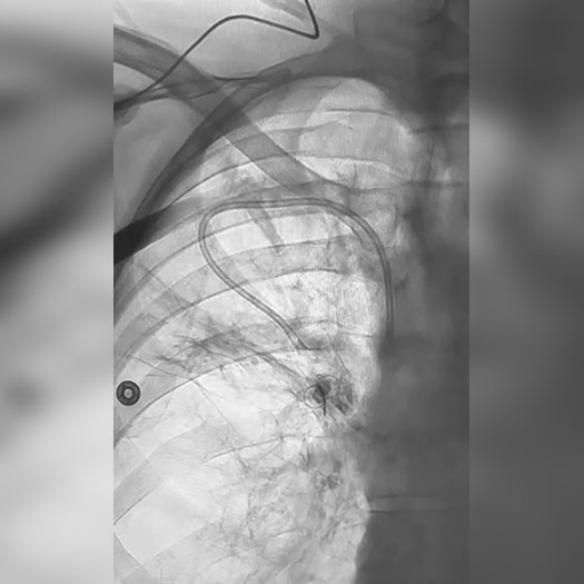 Angiogram of cleared blood vessel in upper extremity