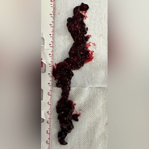 Blood Clot from Upper Extremity