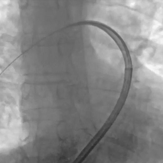 Angiogram of occluded blood vessel
