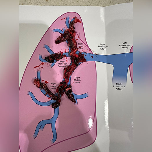 Blood Clot from Right Side Pulmonary Embolism