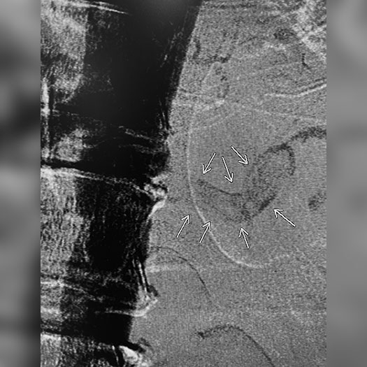 angiogram of occluded renal artery