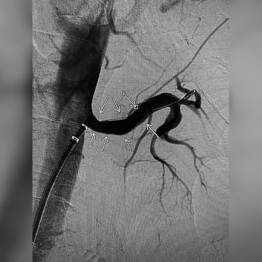 angiogram of occluded renal artery