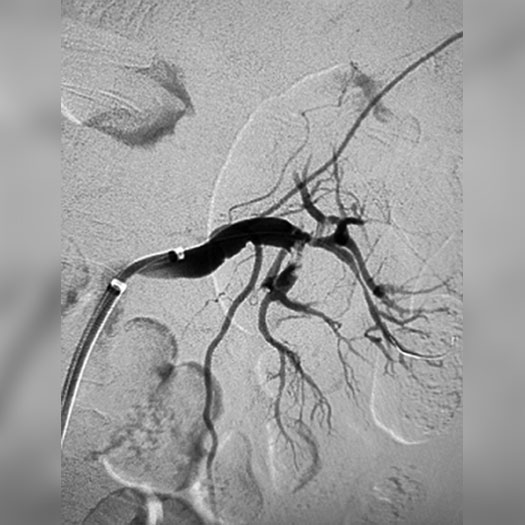angiogram of occluded renal artery