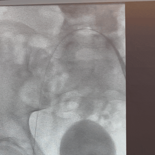 animation of catheter access tracking in iliofemoral vein