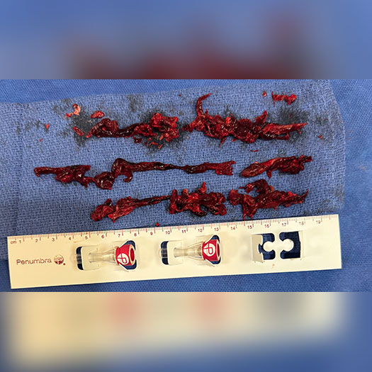 iliofemoral blood clots on blue gauze pad