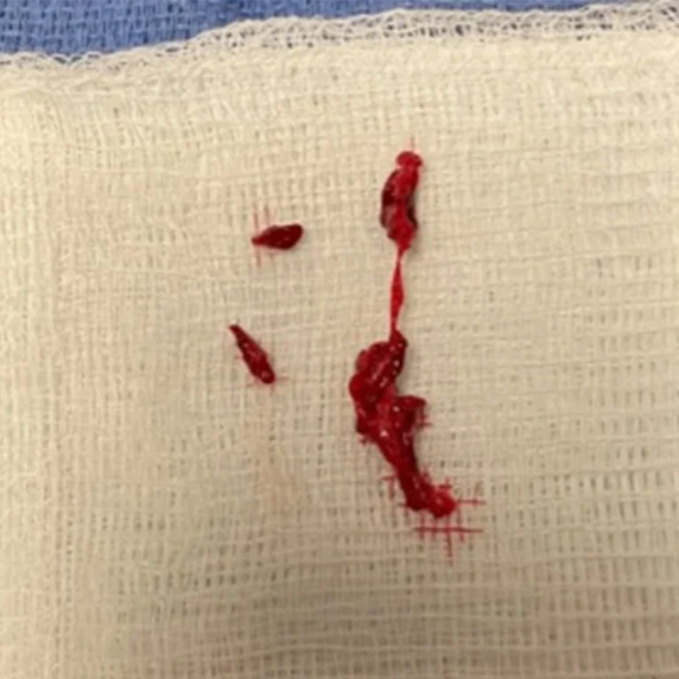 Acute thrombus removed