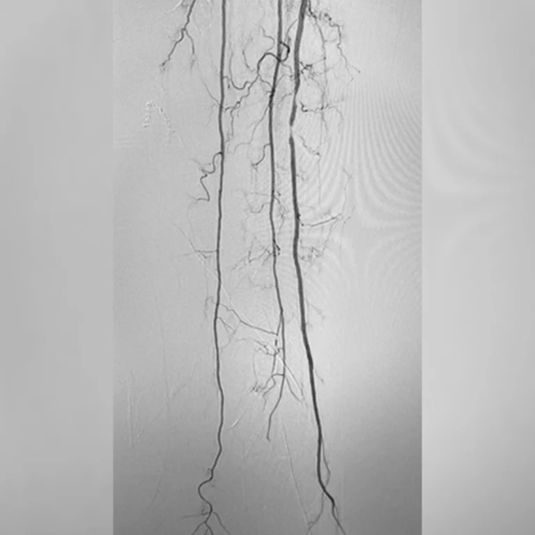 Angiogram of below-the-knee artery
