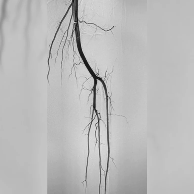 Final angiogram of restored flow