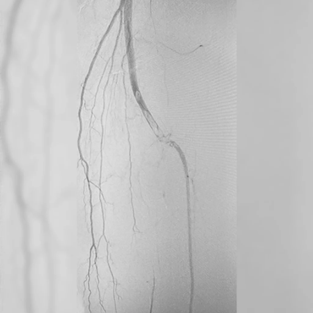 Angiogram of below-the-knee artery