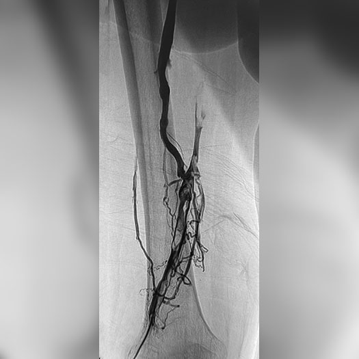 angiogram of occluded iliofemoral vein