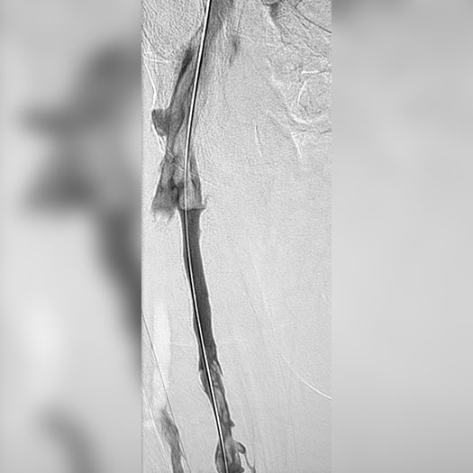 angiogram of occluded iliofemoral vein