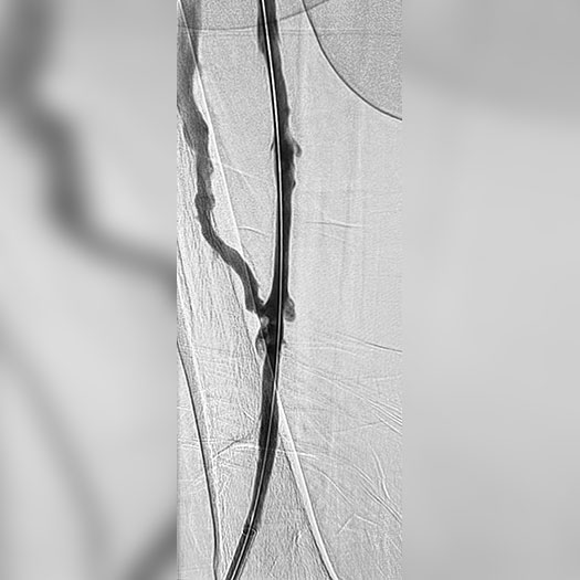 angiogram of cleared iliofemoral vein