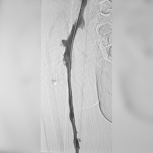 angiogram of cleared iliofemoral vein
