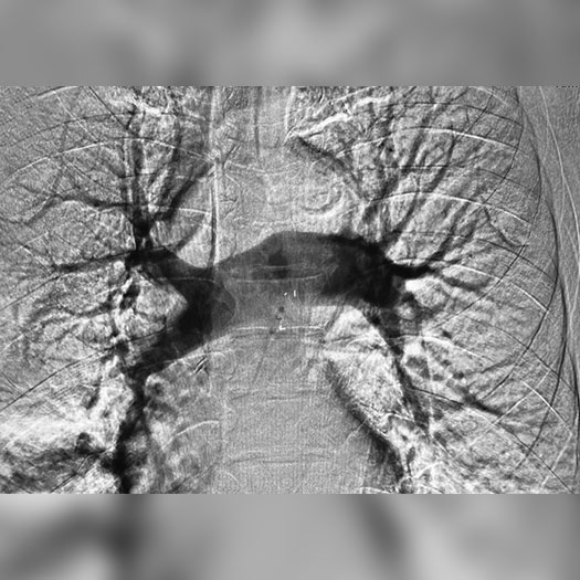 Angiogram of occluded blood vessel in the lungs