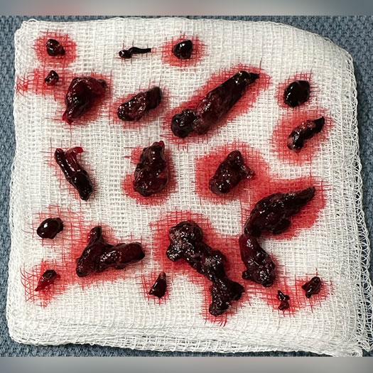 blood clot on gauze pad