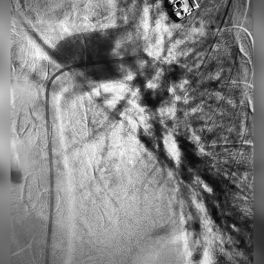 Angiogram of occluded blood vessel in the lung