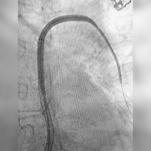 Angiogram of occluded blood vessel in the lung