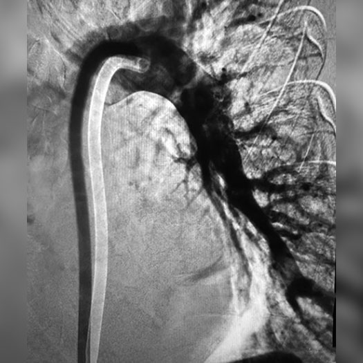 Angiogram of cleared blood vessel in the lung