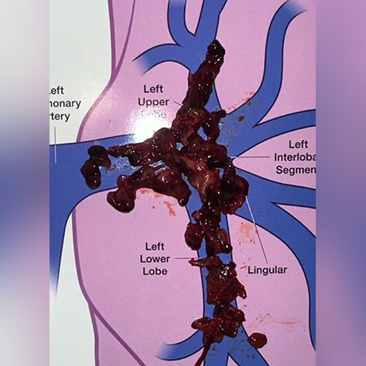 Blood Clot from Left Side Pulmonary Embolism
